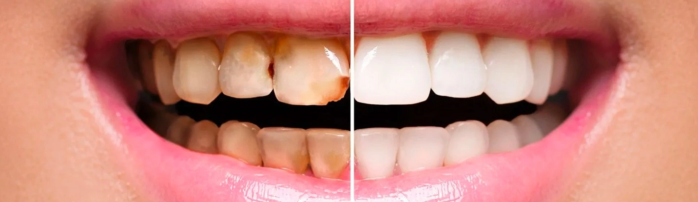 Dental Treatment in Turkey related image