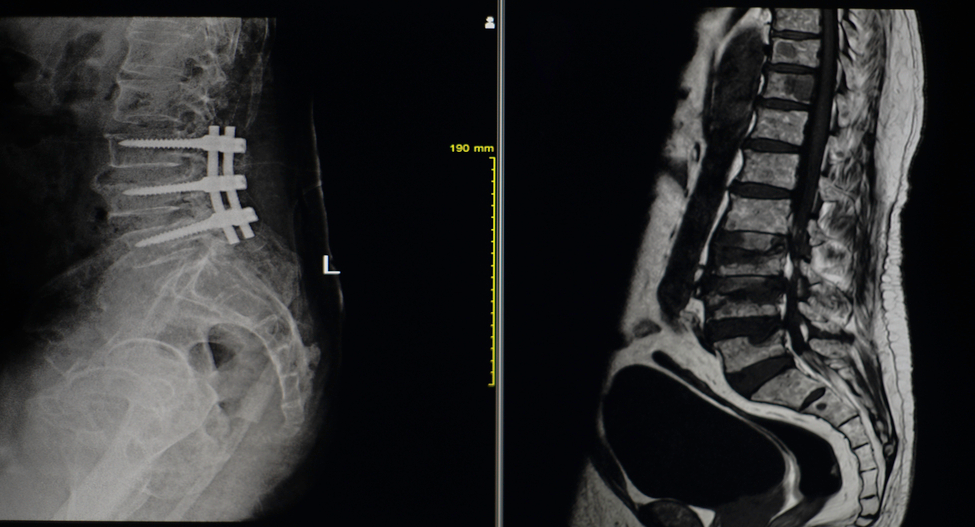 Spinal Fusion Surgery in Switzerland related image
