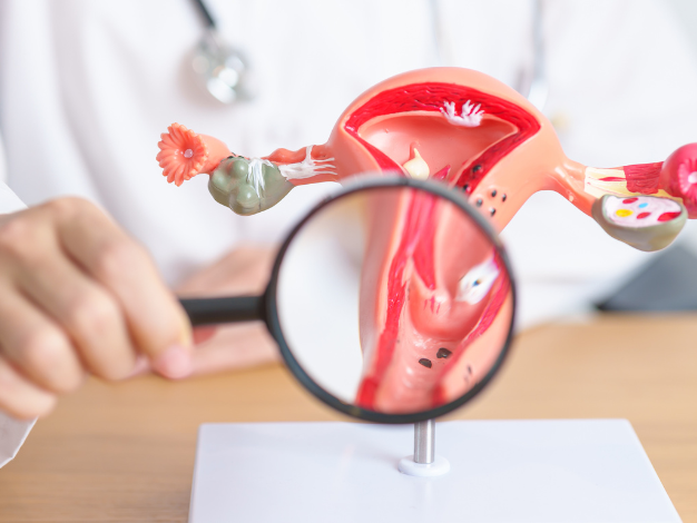 Endometriosis Treatment in Turkey related image