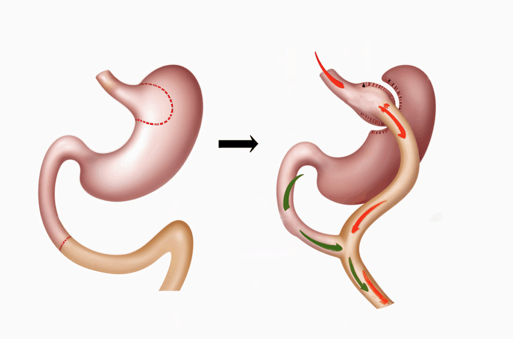 Gastric Bypass Surgery In Turkey: 2026 Prices & Packages related image