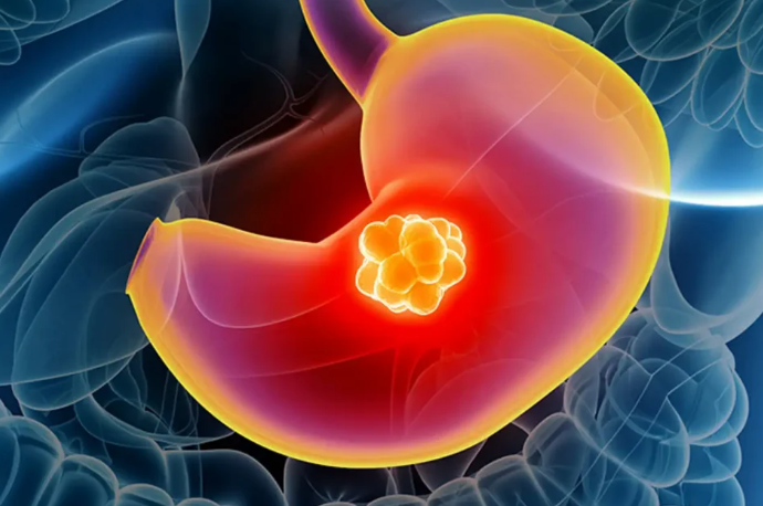 Stomach Cancer Treatment in Turkey related image