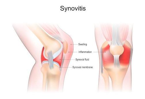 Arthroscopic Knee Surgery in Turkey - Costs and Best Clinics related image