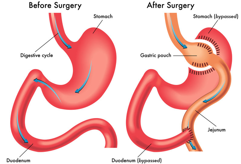 Gastric Bypass Surgery In Turkey: 2026 Prices & Packages related image