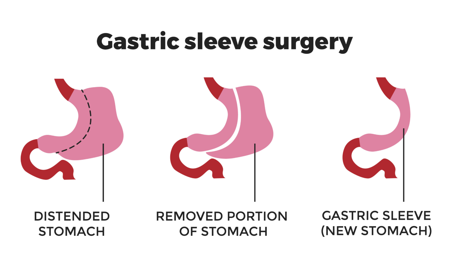 Gastric Sleeve in Turkey | 2026 Prices, & Top Hospitals related image
