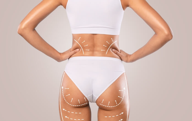 BBL in Turkey (Brazilian Butt Lift) related image