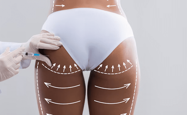 BBL in Turkey (Brazilian Butt Lift) related image