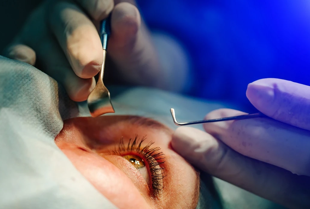 Cataract Surgery Cost in Turkey: Quality and Affordable Eye Care related image