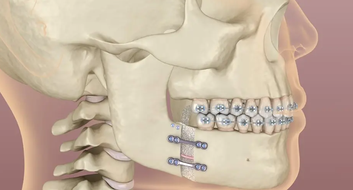 Orthognathic Surgery (Jaw Surgery) in Turkey related image