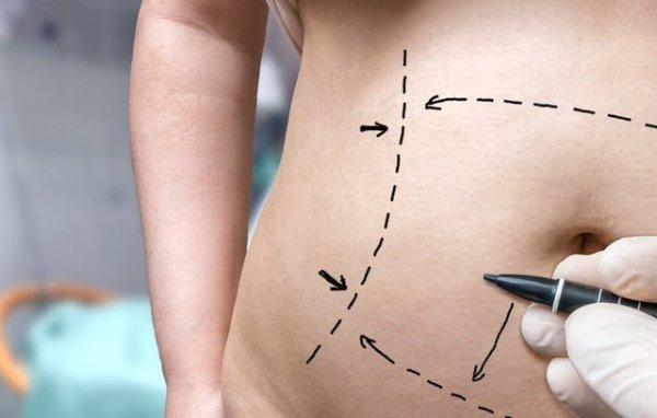 Tummy Tuck Surgery in Tijuana, Mexico related image