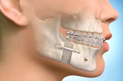 Orthognathic Surgery (Jaw Surgery) in Turkey related image