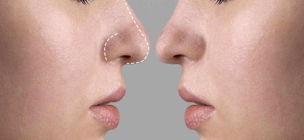 Nose Job Turkey - Affordable Rhinoplasty Packages from 2000€ related image