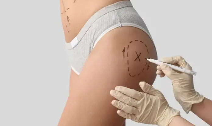 BBL in Turkey (Brazilian Butt Lift) related image