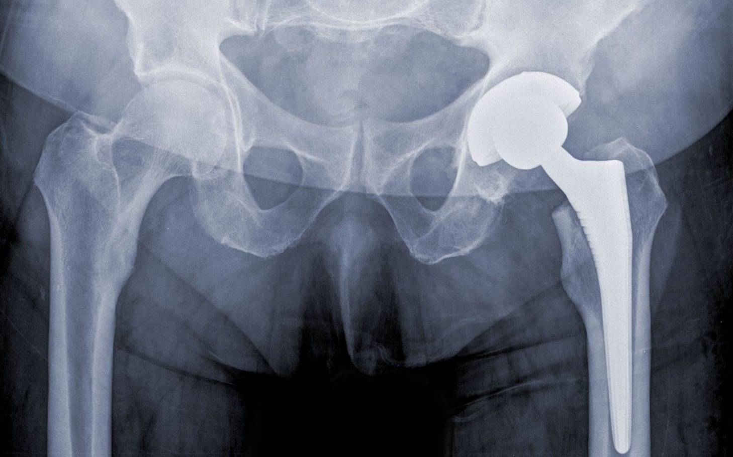 Hip Replacement Surgery in Turkey: Cost, Best Hospitals & Recovery [2026] related image