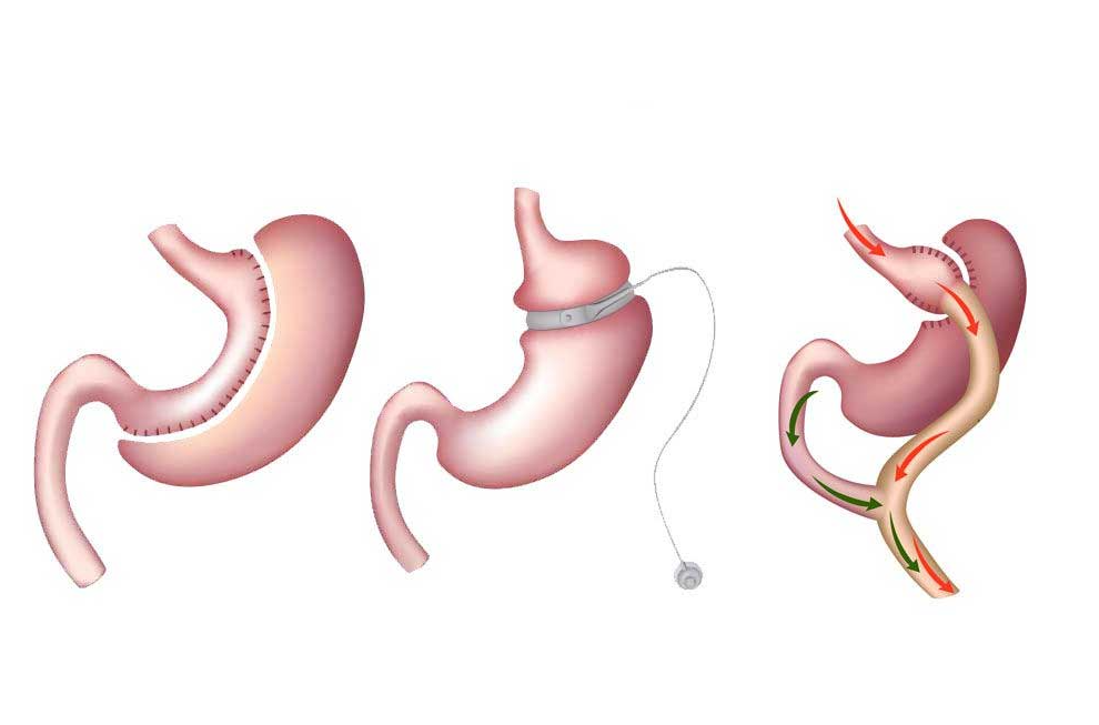 Revision Bariatric Surgery Turkey | 2026 Costs & Clinics related image