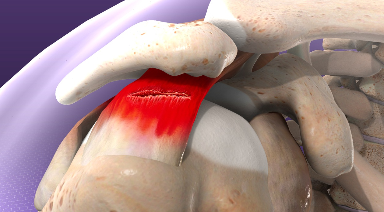 Rotator Cuff Repair in Turkey - Costs, Clinics and Guide related image