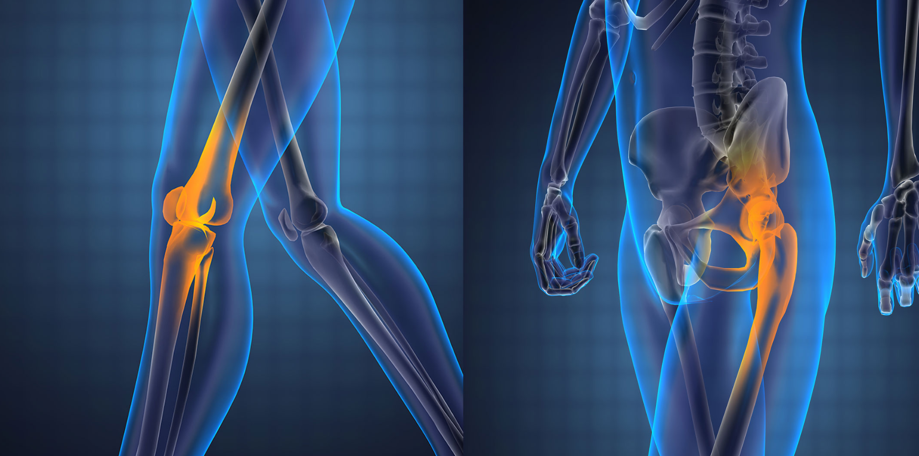 Hip Replacement Surgery in Turkey: Cost, Best Hospitals & Recovery [2026] related image