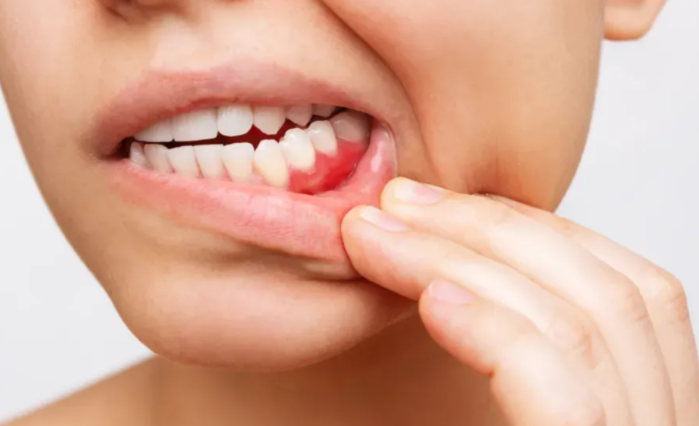 Oral Cancer Treatment in Turkey related image