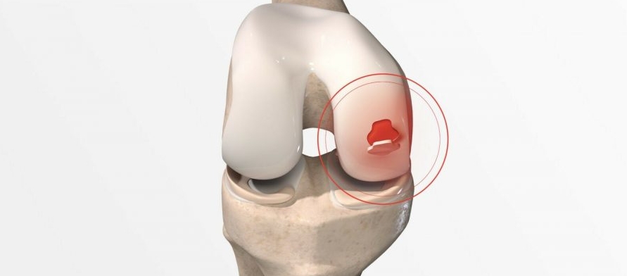 Arthroscopic Knee Surgery in Turkey - Costs and Best Clinics related image