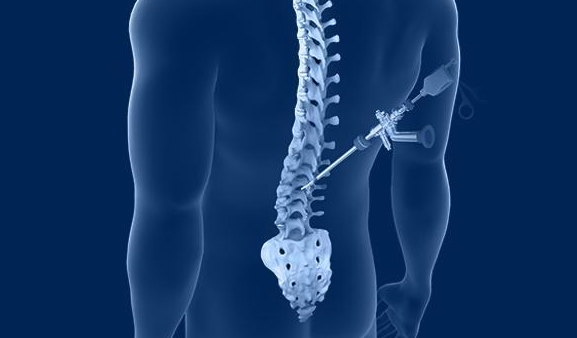 Spine Surgery in Turkey related image
