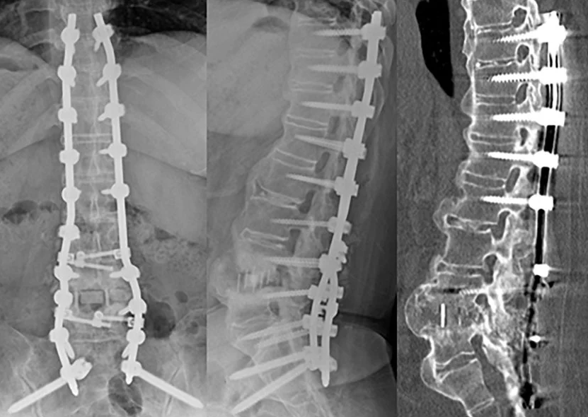Spinal Fusion Surgery in Switzerland related image