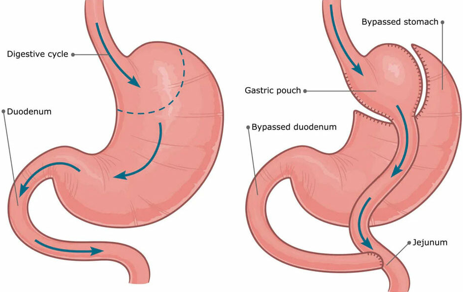 Gastric Balloon In Turkey: Guaranteed Results & 2026 Costs related image