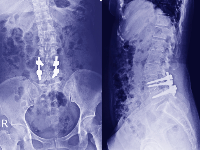 Spinal Fusion Surgery in Switzerland related image