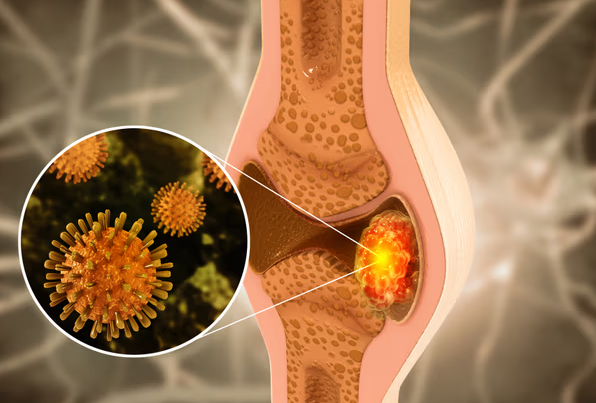 Bone Cancer Treatment in Turkey related image