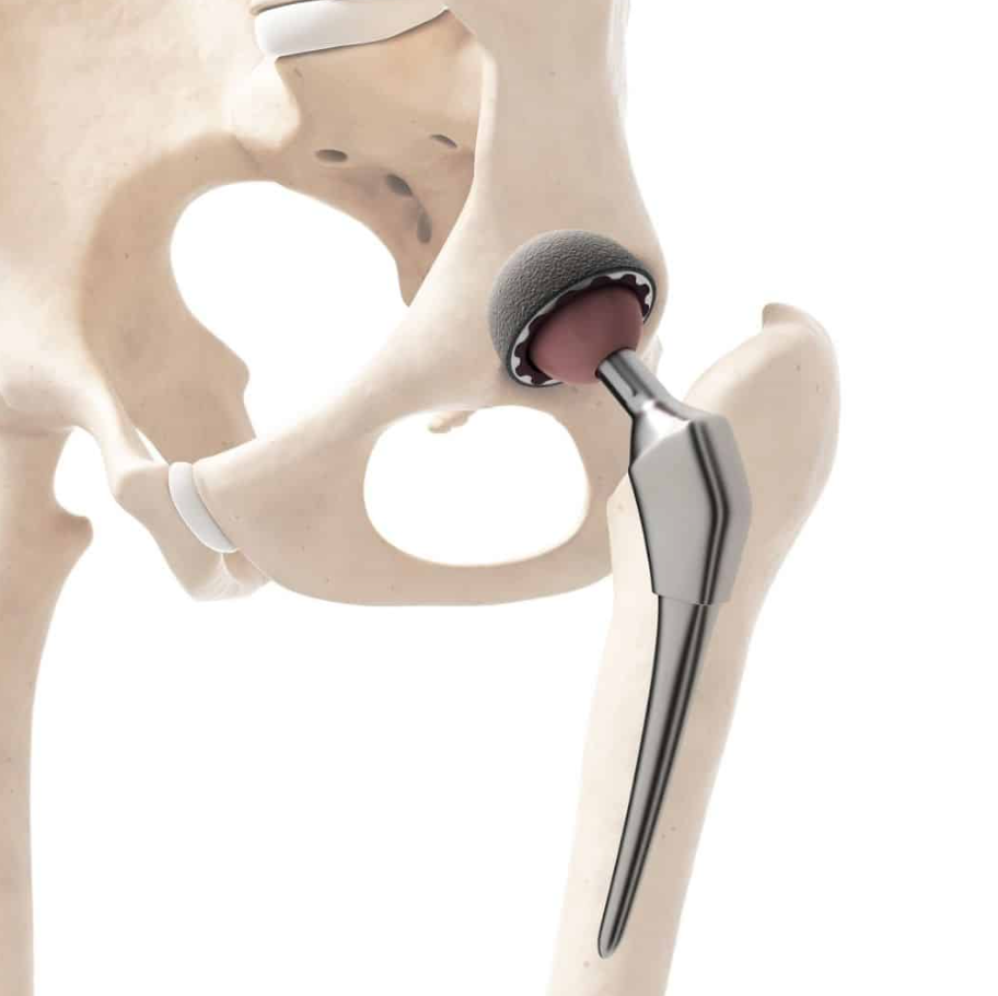 Hip Replacement Surgery in Turkey: Cost, Best Hospitals & Recovery [2026] related image
