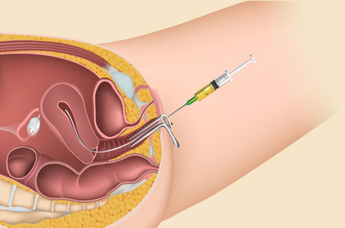 IUI Treatment in Turkey related image