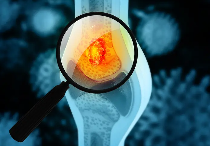 Bone Cancer Treatment in Turkey related image