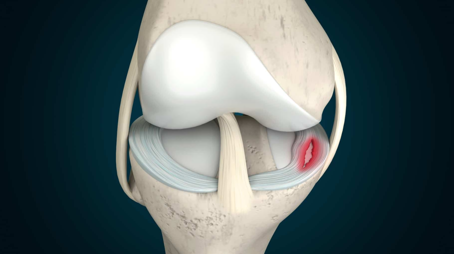 Arthroscopic Knee Surgery in Turkey - Costs and Best Clinics related image