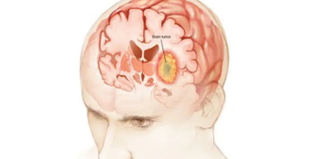 Brain Tumour Treatment in Turkey | 2026 Costs, Clinics related image