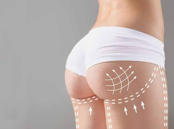BBL in Turkey (Brazilian Butt Lift) related image