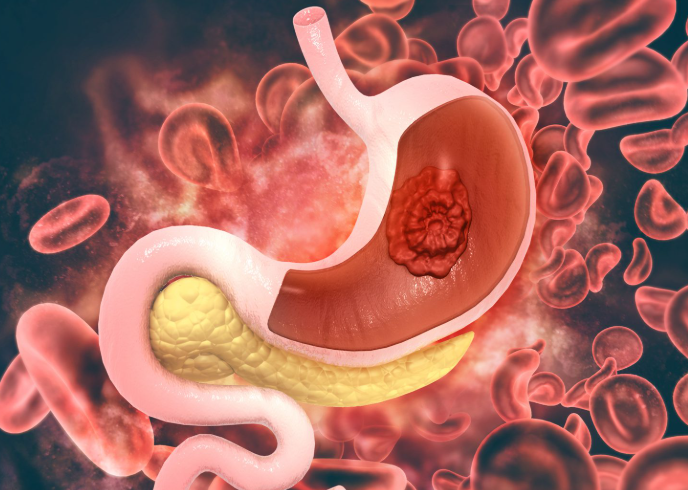 Stomach Cancer Treatment in Turkey related image