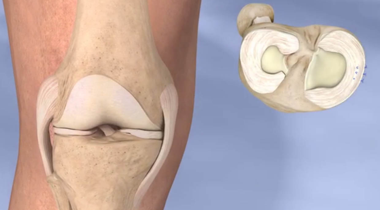 Arthroscopic Knee Surgery in Turkey - Costs and Best Clinics related image