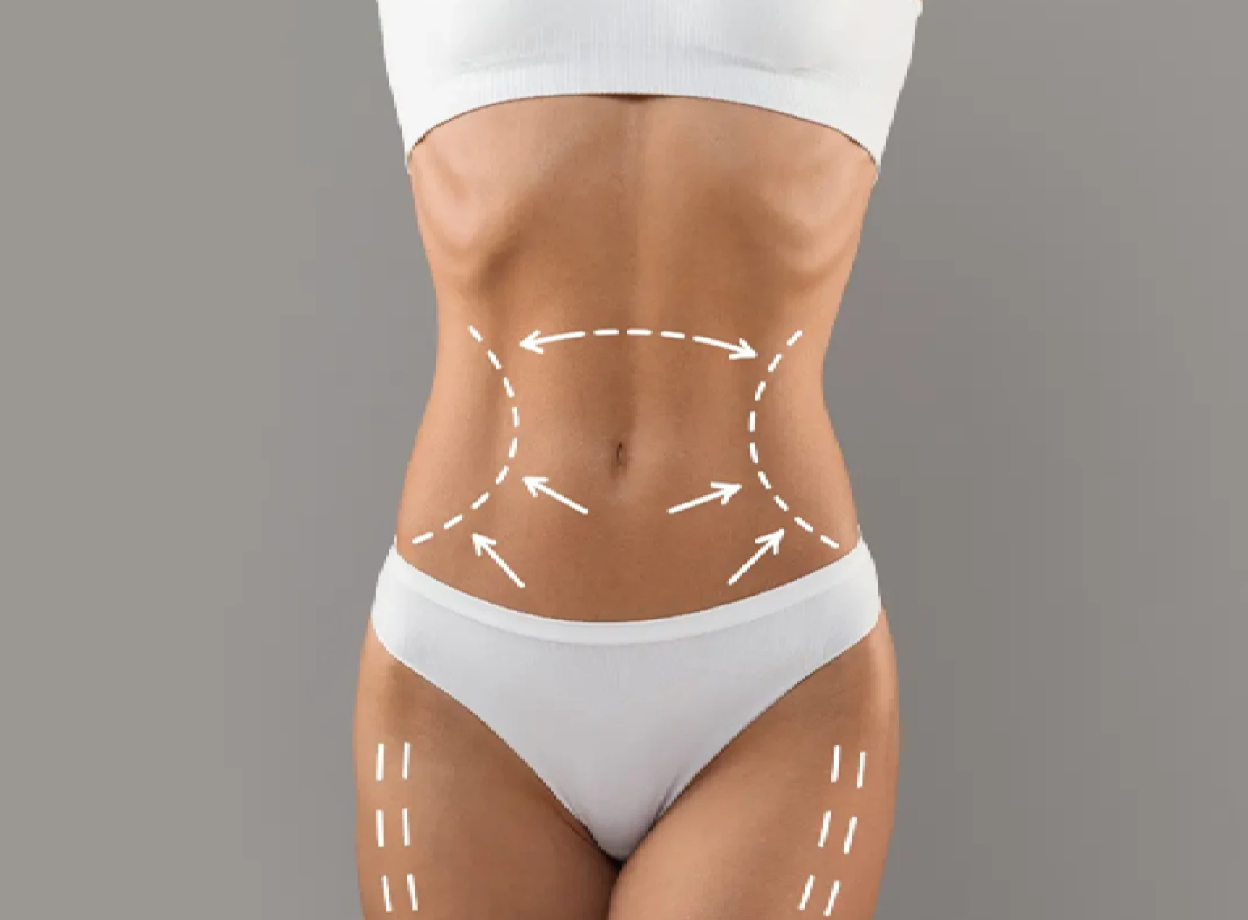Vaser Liposuction in Turkey related image