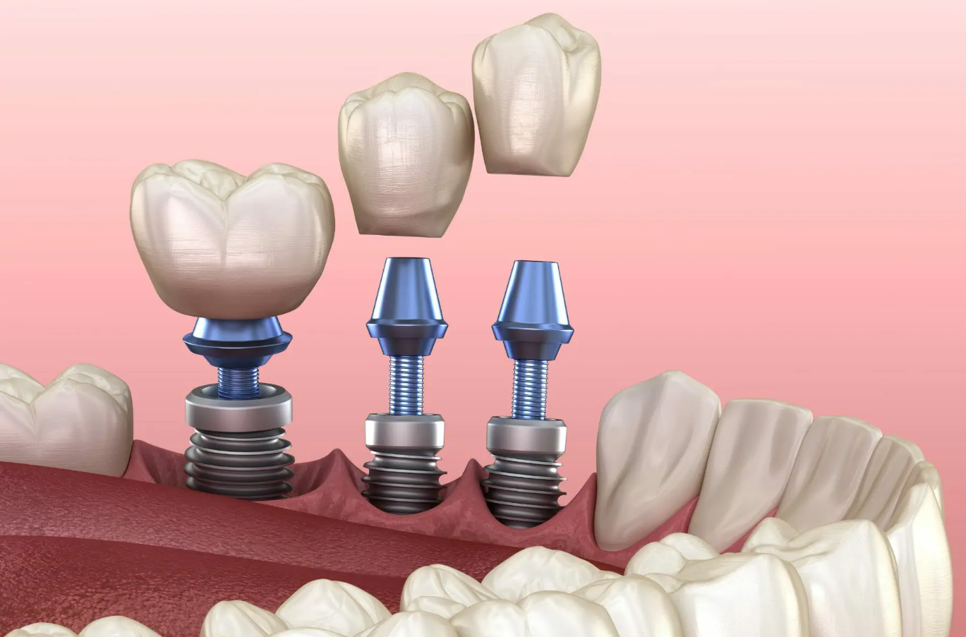 All-on-8 Dental Implants in Turkey related image