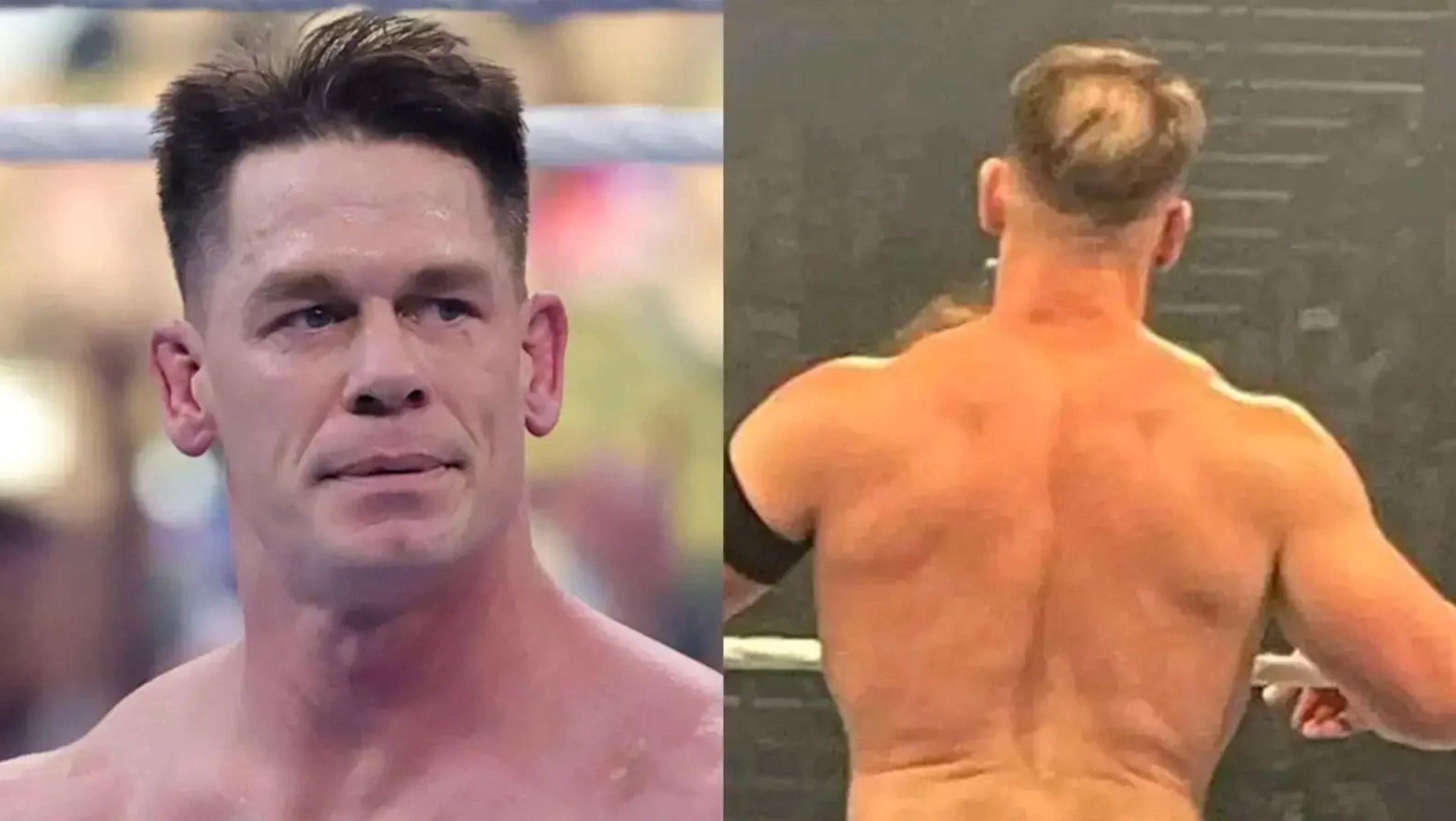 Celebrity Hair Transplants: Confirmed Cases, Costs, Photos related image