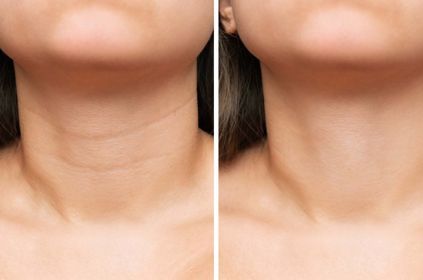 Neck Lift in Turkey related image