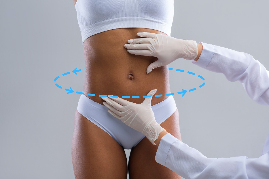 360 Liposuction in Turkey related image