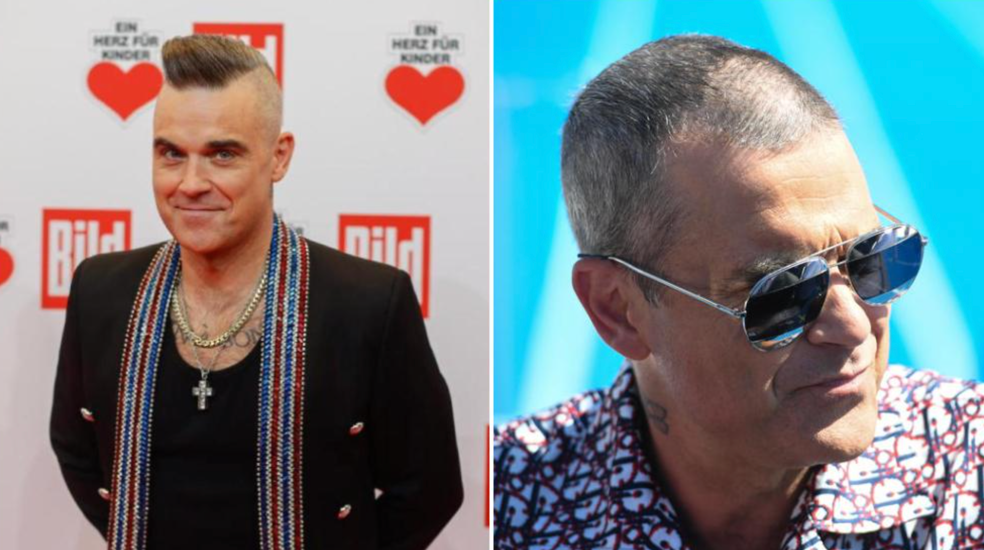 Celebrity Hair Transplants: Confirmed Cases, Costs, Photos related image