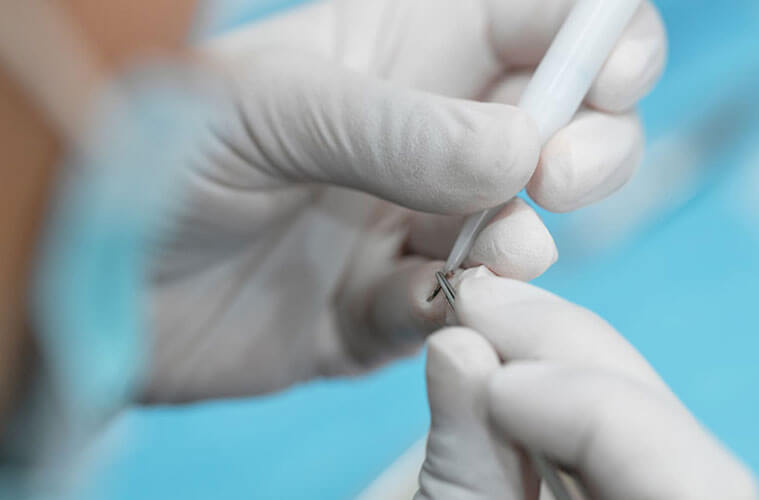 DHI Hair Transplant in Turkey related image