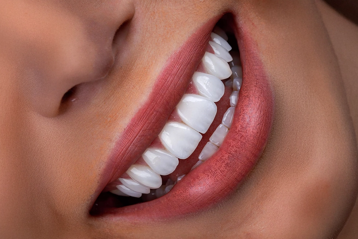 Hollywood Smile in Turkey related image