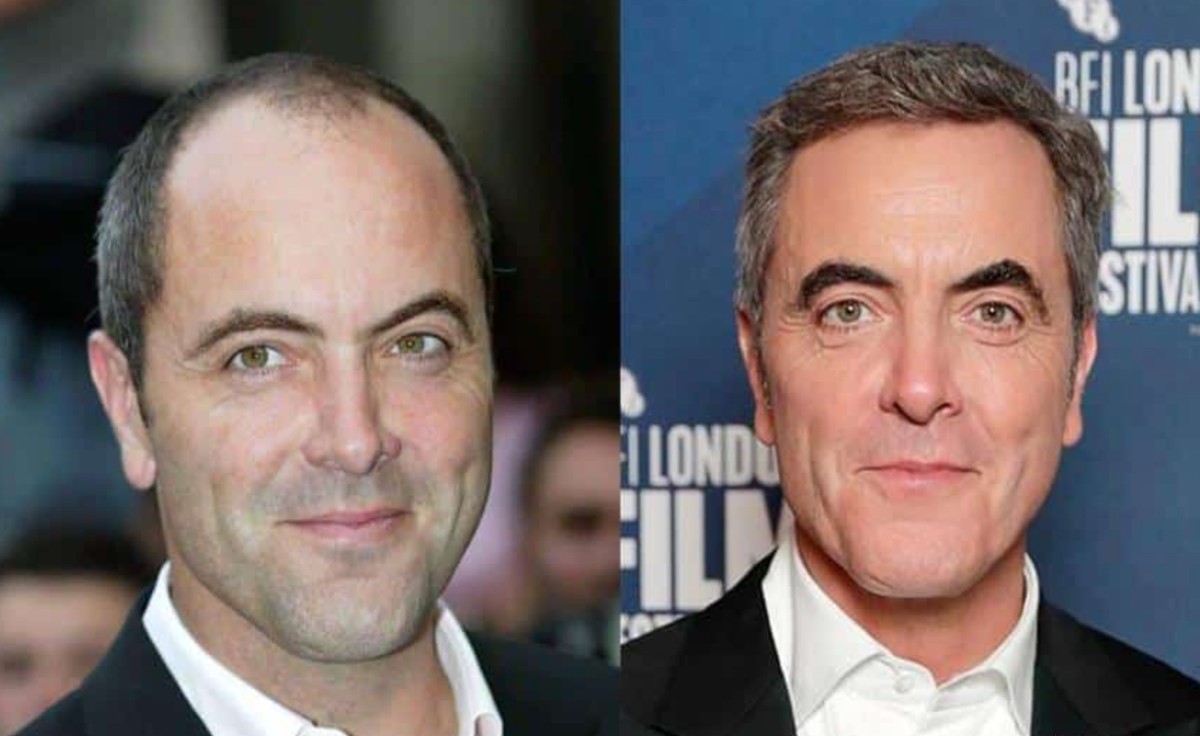 Celebrity Hair Transplants: Confirmed Cases, Costs, Photos related image