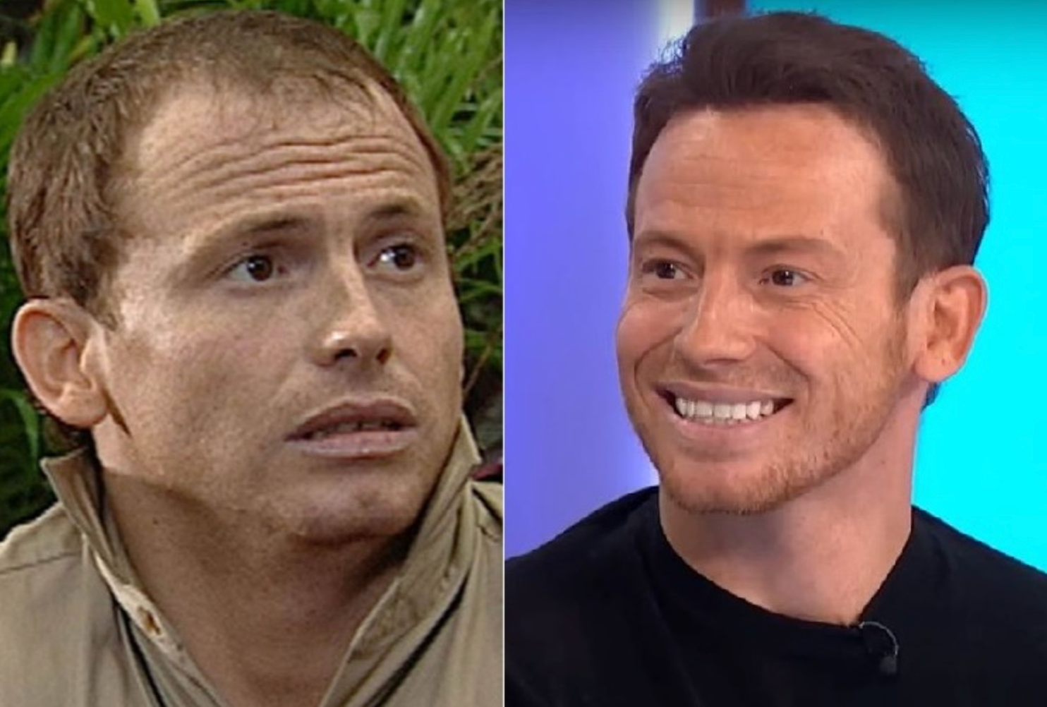 Celebrity Hair Transplants: Confirmed Cases, Costs, Photos related image