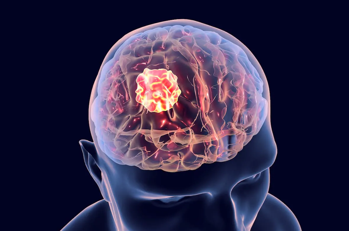 Glioblastoma Treatment Abroad related image