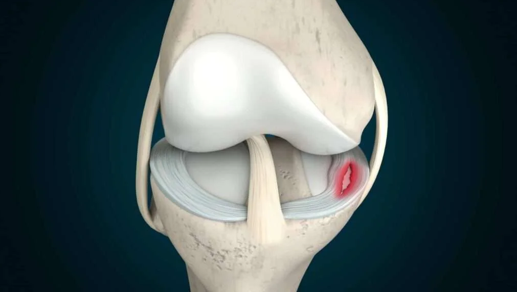 Meniscus Surgery in Croatia related image