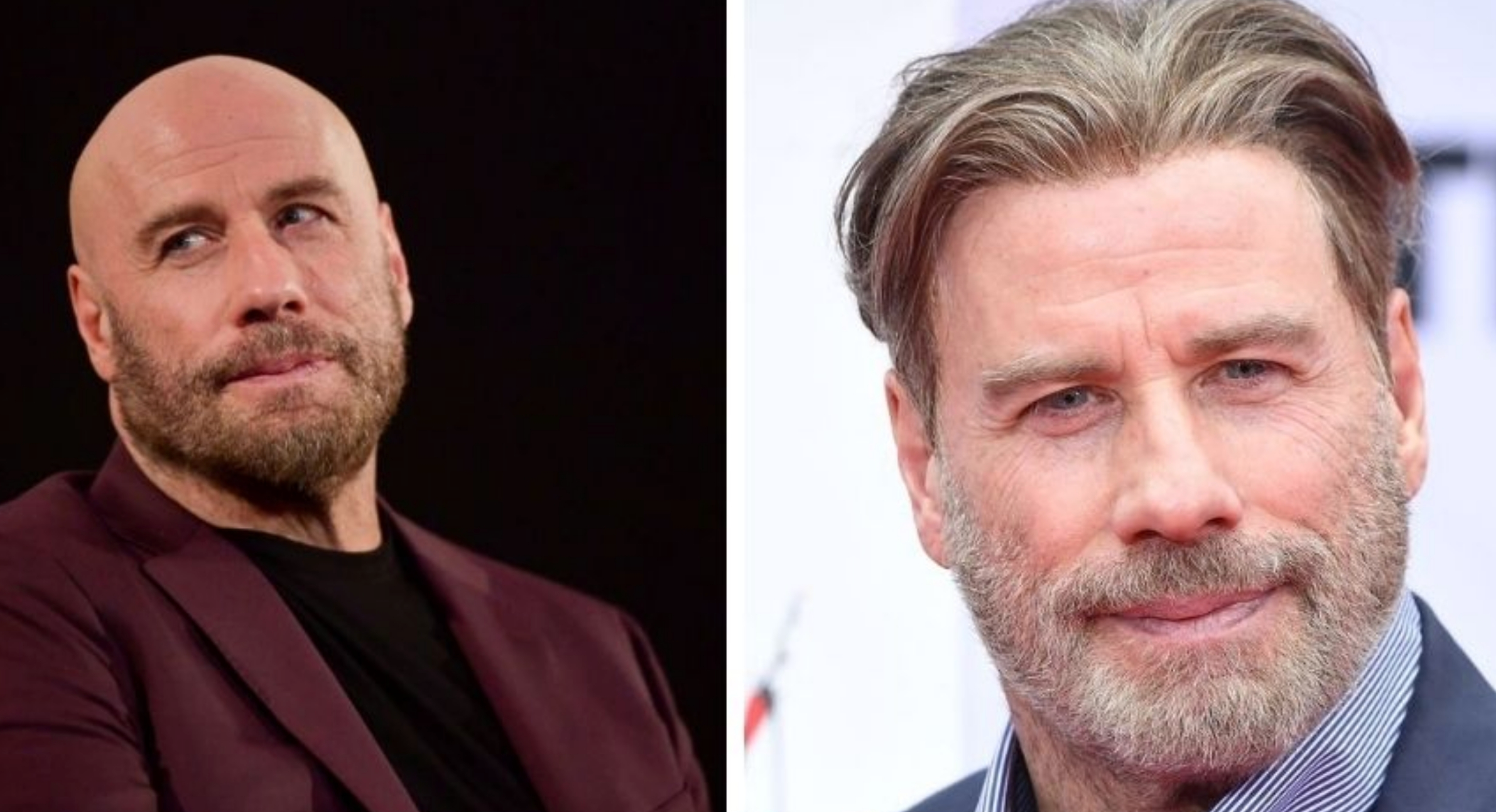 Celebrity Hair Transplants: Confirmed Cases, Costs, Photos related image
