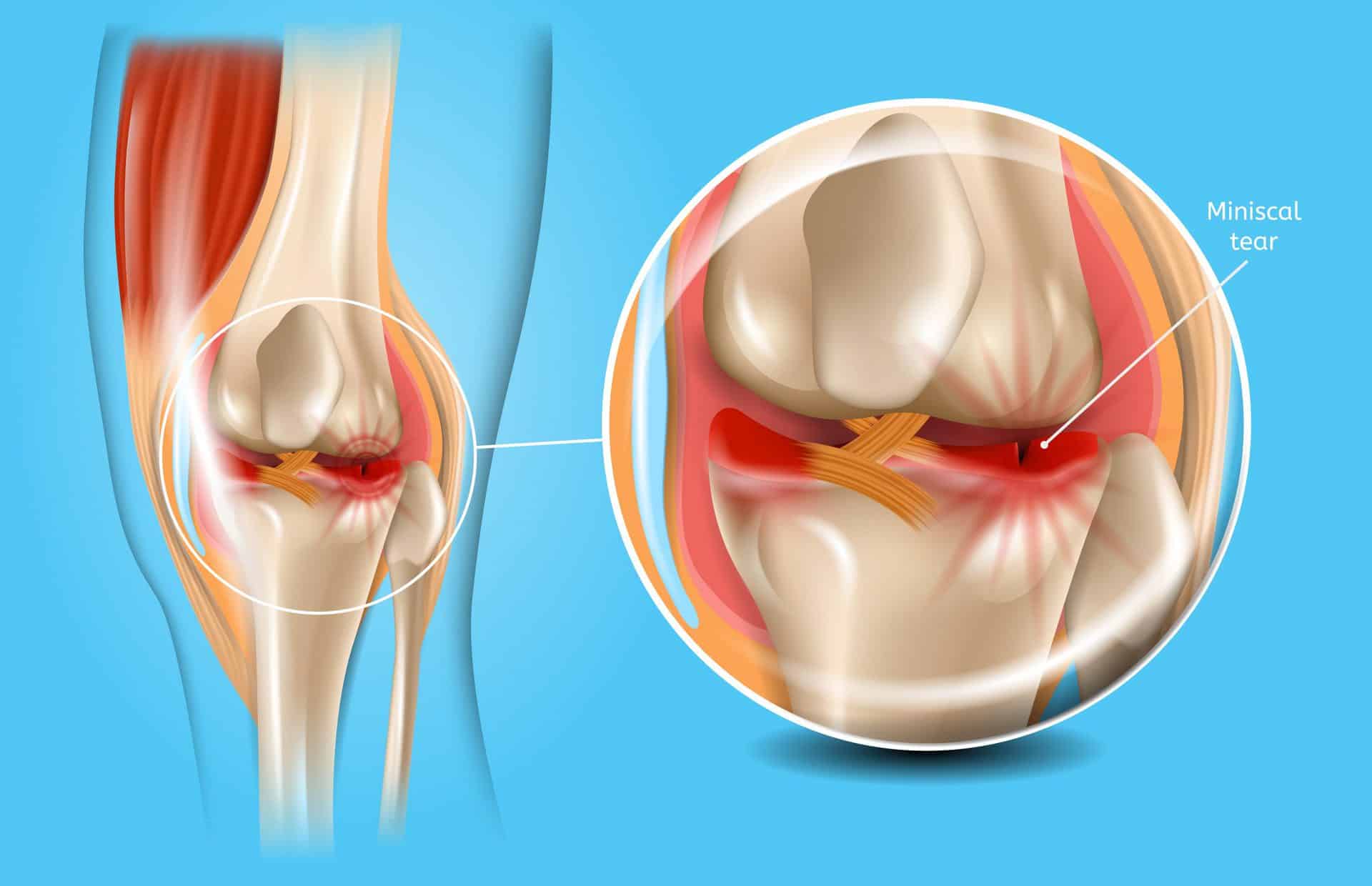 Meniscus Surgery in Croatia related image