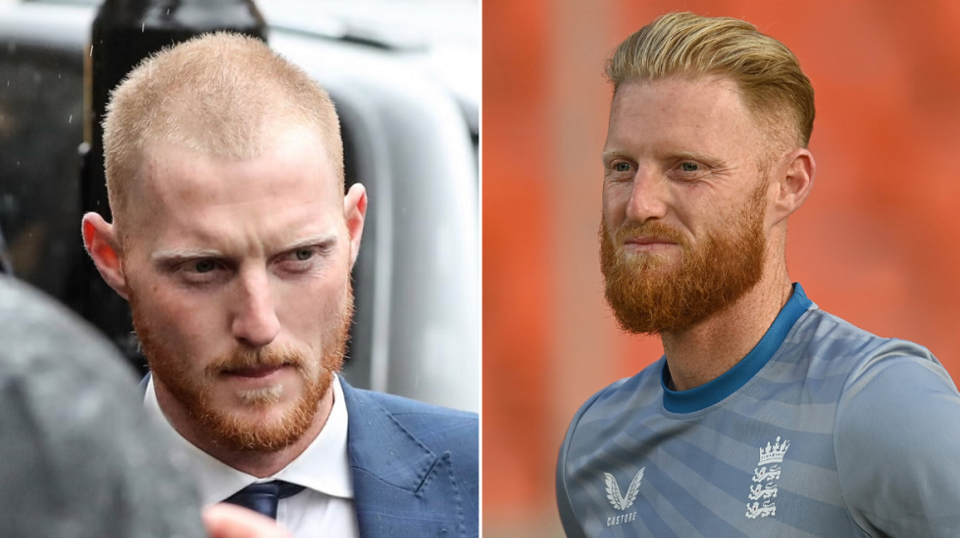 Celebrity Hair Transplants: Confirmed Cases, Costs, Photos related image